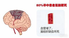 1分钟搞清楚:卒中、中风、脑梗、脑溢血,关键时能救命
