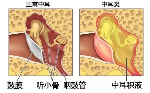 中耳炎