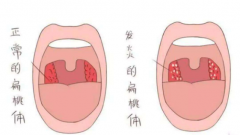 六种方法搞定扁桃体周围脓肿