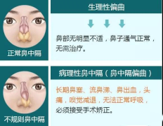 鼻中隔偏曲和鼻甲肥大有什么区别呢？