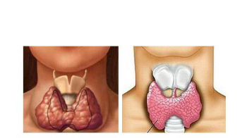甲状腺瘤,病因,到底,是,什么