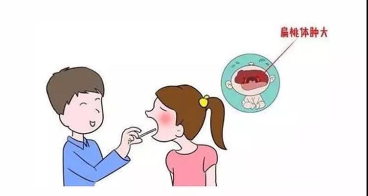 扁桃体肥大