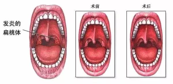 扁桃体肿大应当如何应对