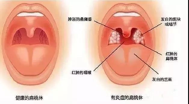 扁桃体炎