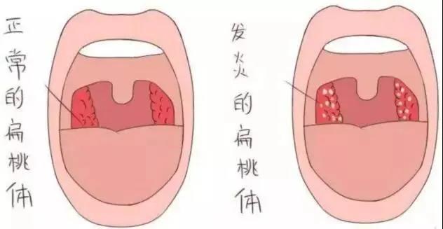 扁桃体炎