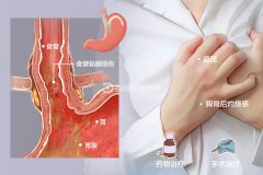 嗓子有异物感不一定是咽炎，也可能是胃食管反流