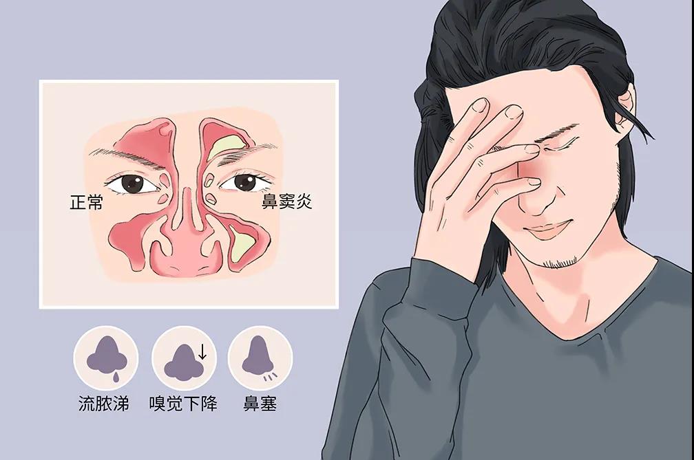 急性鼻窦炎