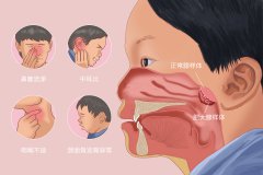 【仁品科普】不是所有的腺样体都需要手术治疗，腺样体攻略拿走不谢！