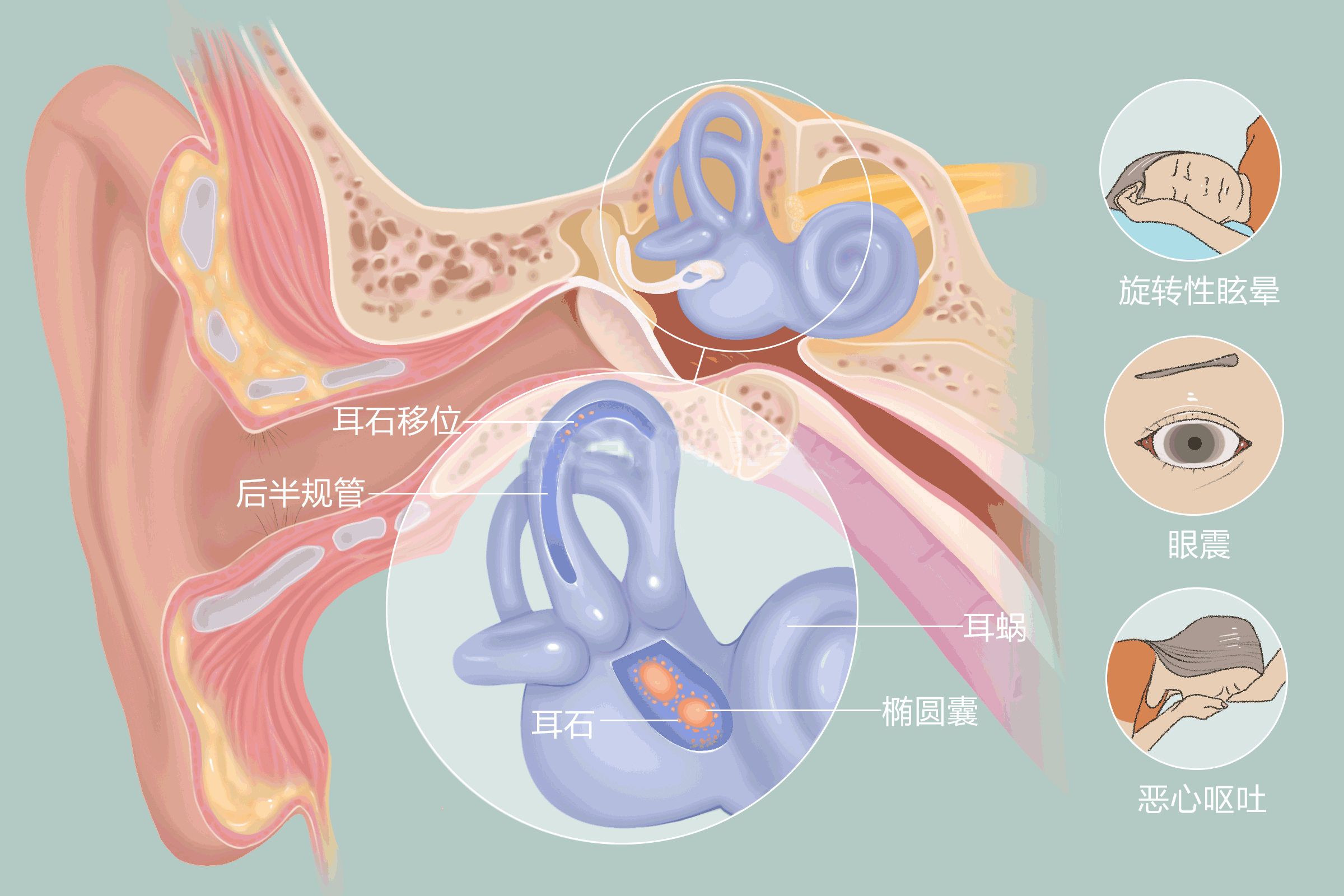 耳石症的5个特征表现