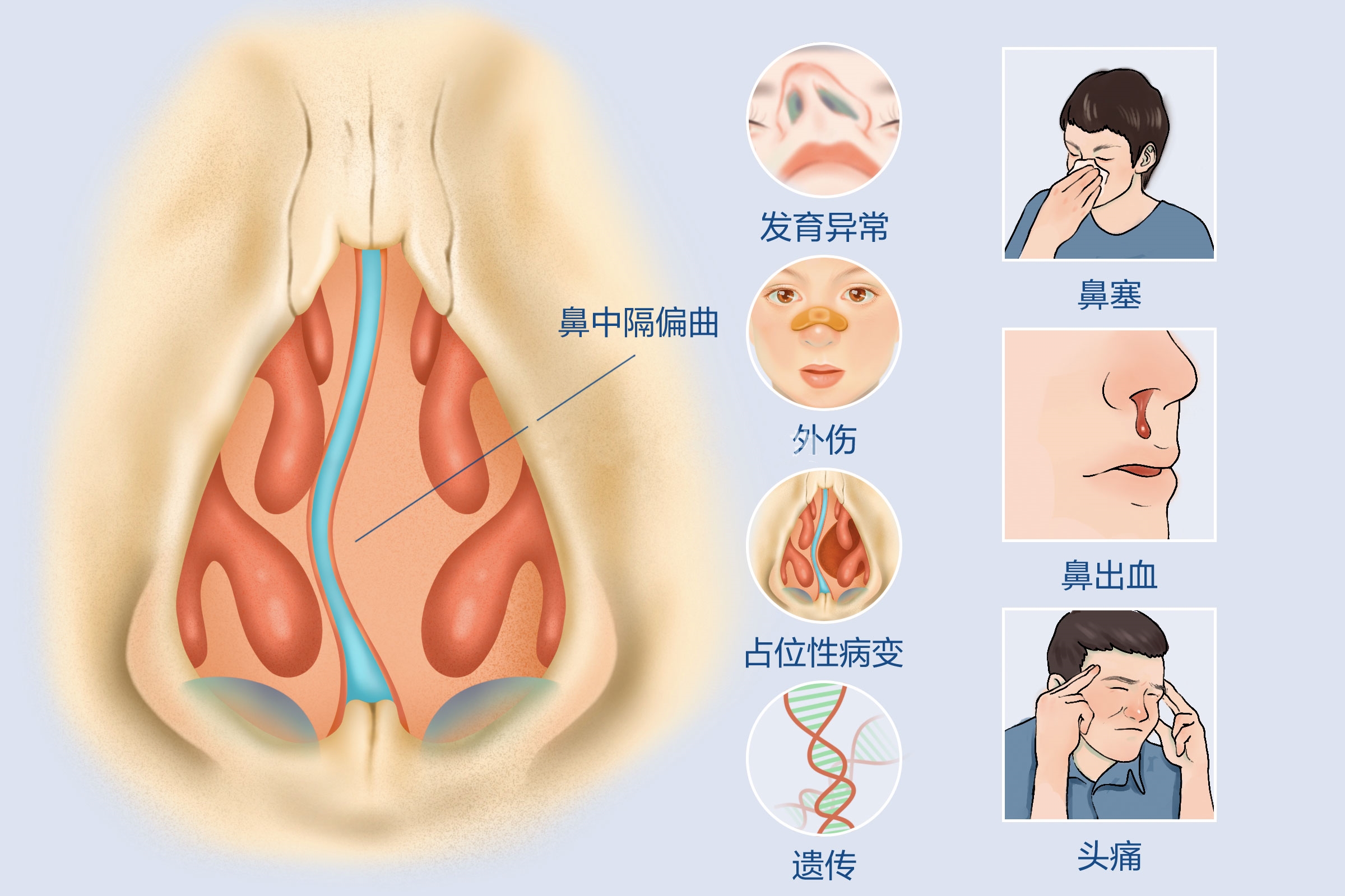 重庆治疗鼻中隔偏曲医院