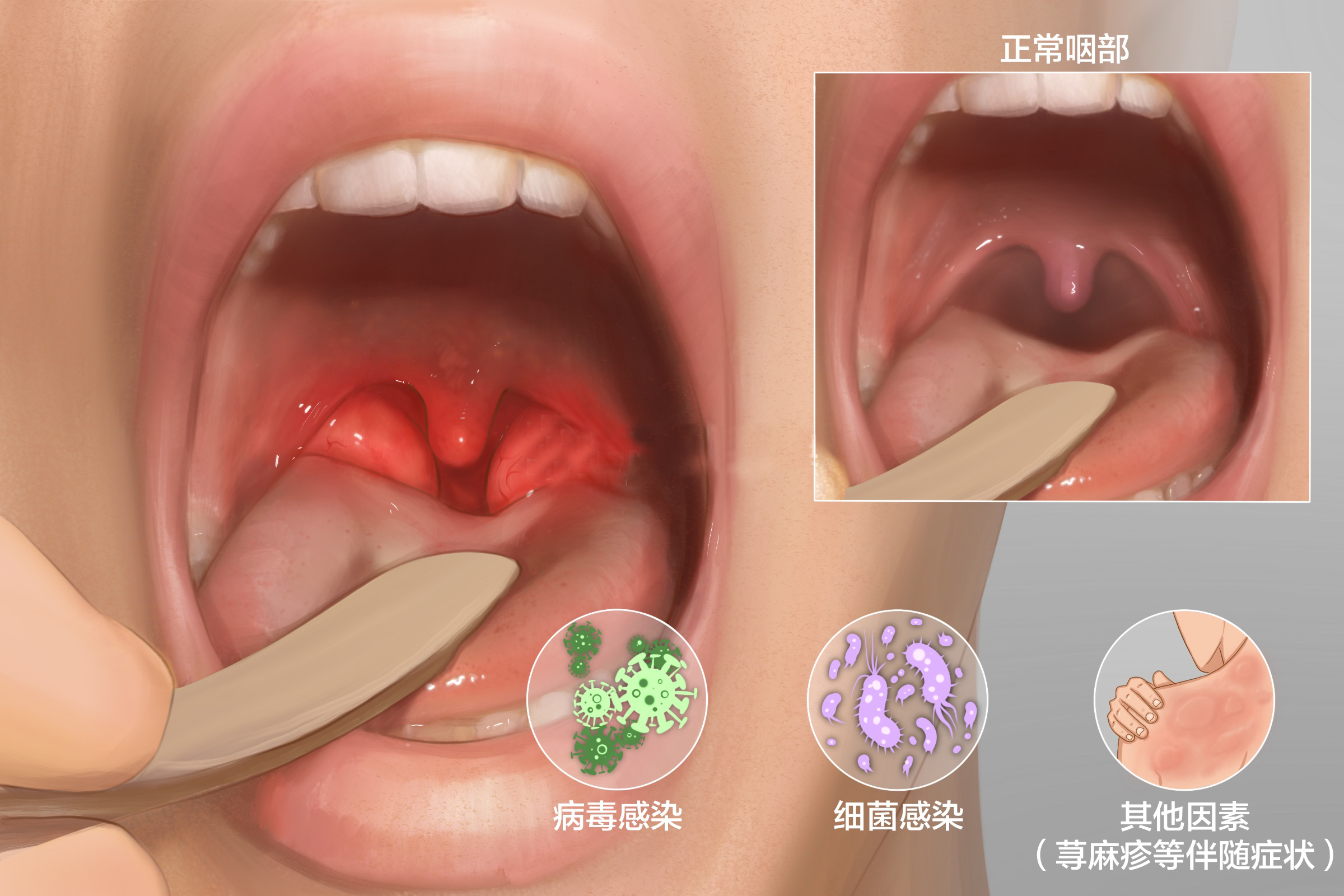 急性咽炎