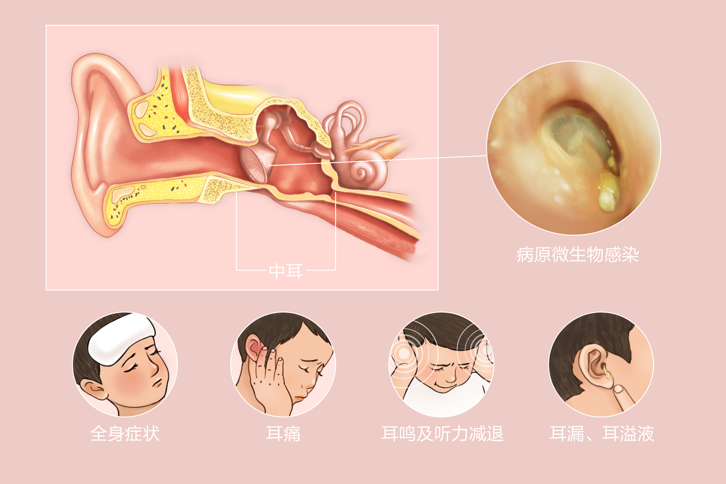 重庆中耳炎