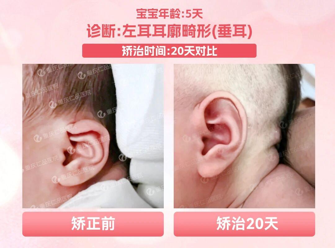 小耳畸形不止手术，仁品医院多维度干预方案+基金援助，为患者提供多元选择